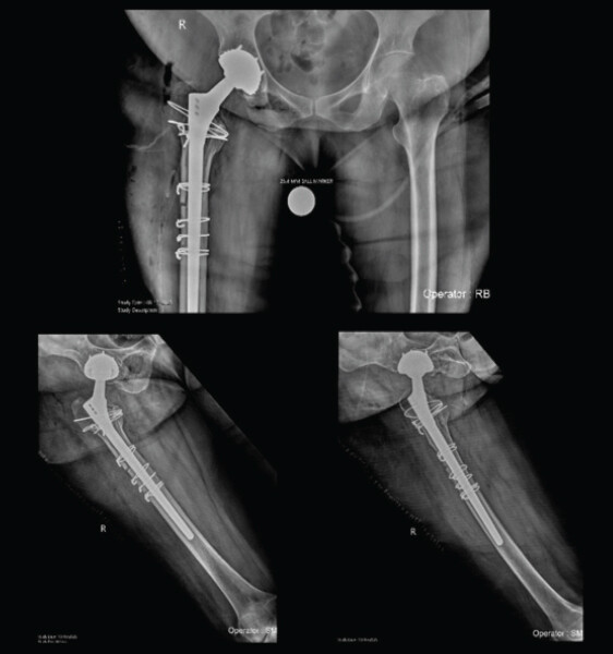 Figure 5: Post-operative radiographs in anteroposterior and lateral views of the right hip taken after weight bearing. A stable diaphyseal stem is seen with cerclage wires of the greater trochanter, with 3 cerclage wires over the cortical window and one cerclage wire above the window. An uncemented dual mobility cup and head are also seen.