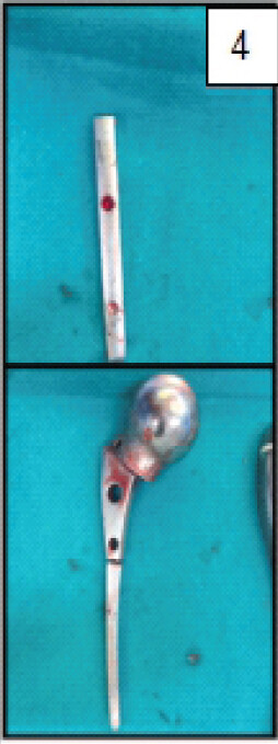 Figure 4: Images of the fractured prosthesis removed..