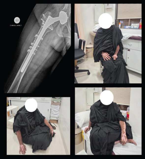Figure 6: Radiographs at 3 months after revision surgery showing a stable implant, with a maintained alignment and satisfactory osseointegration with no subsidence or loosening. The accompanying pictures show the patient comfortably capable of sitting cross-legged on the floor and on an examination couch.