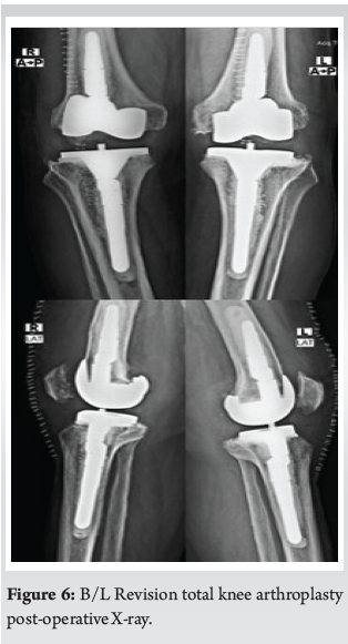 Polyethylene Insert Wear Leading to Early Aseptic Bilateral Total Knee ...