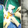 Functional Outcome of Operative Titanium Elastic Nailing System Versus Non-Operative Figure-of-Eight Bandage in Displaced Mid-Shaft Clavicle Fractures: A Randomized Controlled Study