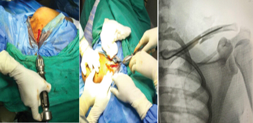 Figure 1: Surgery position: Patient lying in beach chair position, preoperative positioning and surgical draping for clavicle fracture fixation, opening the medial clavicular cortex to introduce the TENS, Operative step showing creation of entry portal for intramedullary fixation of clavicle fracture and C-arm guidance during advancement of TENS in the clavicle medullary canal. TENS: Titanium elastic nailing system.
