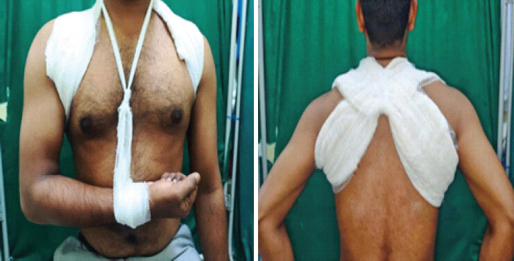 Figure 2: Figure-of-eight bandage (Indira Gandhi Medical College hospital and Research institute).