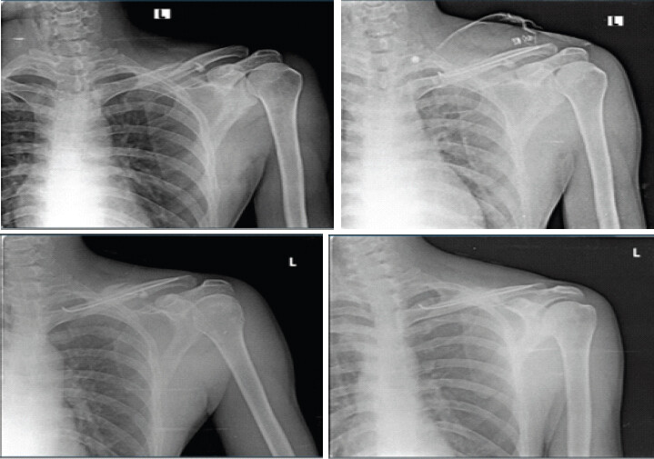 Figure 3: Preoperative X-ray showing displaced midshaft clavicle fracture prior to TENS fixation (Pre-operative), 2-week postoperative X-ray showing TENS in situ with maintained fracture alignment, 6-week postoperative X-ray demonstrating early callus formation and progressing union after TENS fixation and 6-month postoperative X-ray showing complete fracture union with TENS in situ. TENS: Titanium elastic nailing system.