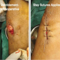 Figure 1: Different stages of management of Case 1 till complete healing