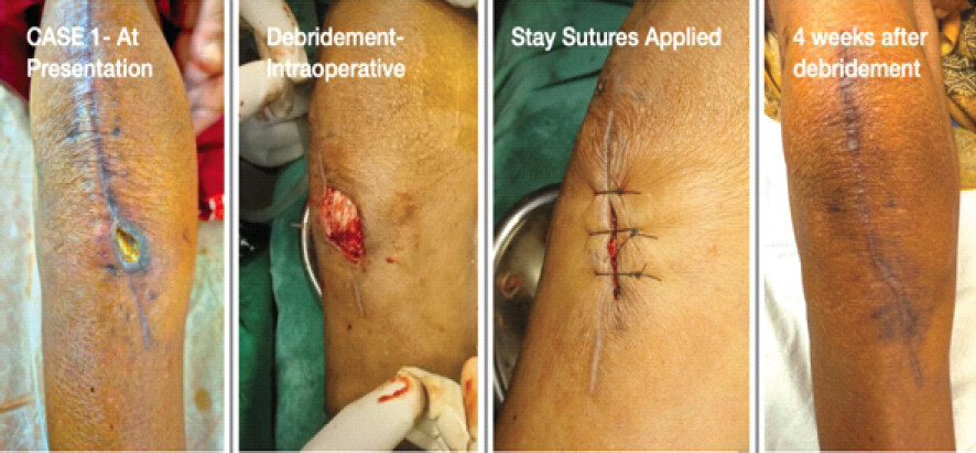 Figure 1: Different stages of management of Case 1 till complete healing