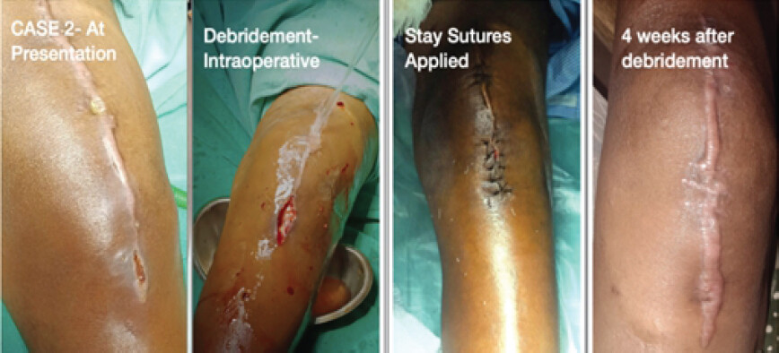 Figure 2: Different stages of management of Case 2 till complete healing