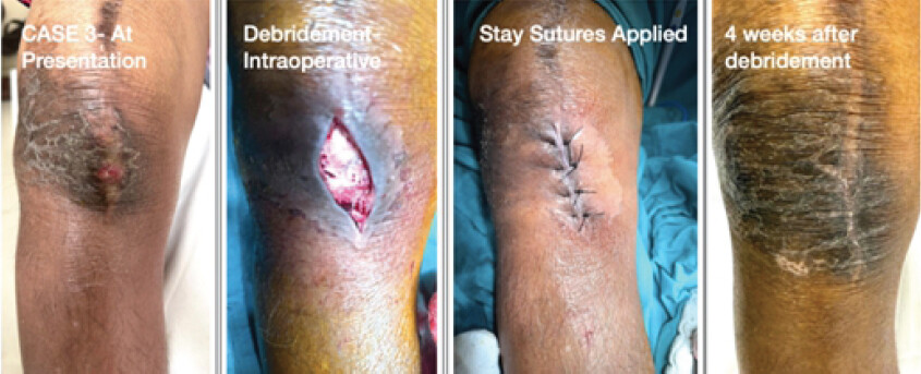 Figure 3: Different stages of management of Case 2 till complete healing