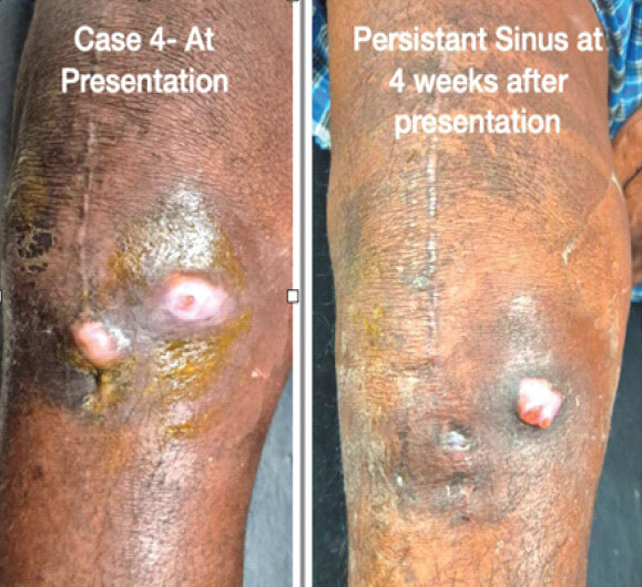 Figure 4: Stages of the 4th case without debridement at presentation and persistent sinus even after 4 weeks of presentation.