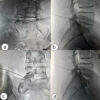 Clinical Effectiveness of Intradiscal Ozone Therapy with or Without Periforaminal Steroid Injection in Lumbar Disc Herniation: Revisiting an Underutilized Treatment