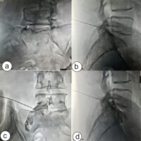 Figure 1: Fluoroscopic images of spinal needle inserted in L5-S1 intradiscal space. (a) Oblique fluoroscopic view demonstrating posterolateral needle advancement toward the L5-S1 intradiscal space. (b) Lateral fluoroscopic view confirming needle placement within the posterior third of the disc. (c) Post-contrast anteroposterior fluoroscopic view demonstrating appropriate intradiscal spread of contrast material. (d) Post-contrast lateral fluoroscopic view confirming adequate intradiscal distribution prior to ozone injection.