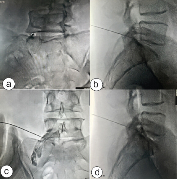 Figure 1: Fluoroscopic images of spinal needle inserted in L5-S1 intradiscal space. (a) Oblique fluoroscopic view demonstrating posterolateral needle advancement toward the L5-S1 intradiscal space. (b) Lateral fluoroscopic view confirming needle placement within the posterior third of the disc. (c) Post-contrast anteroposterior fluoroscopic view demonstrating appropriate intradiscal spread of contrast material. (d) Post-contrast lateral fluoroscopic view confirming adequate intradiscal distribution prior to ozone injection.