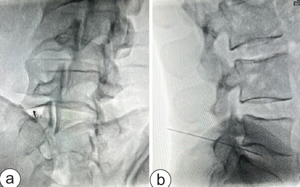 Figure 2: Fluoroscopic-guided periforaminal needle placement prior to steroid injection. (a) Oblique fluoroscopic view demonstrating posterolateral needle advancement toward the neural foramen at the target level (arrow indicating needle tip position adjacent to the exiting nerve root). (b) Lateral fluoroscopic view confirming appropriate periforaminal needle placement within the neural foramen prior to administration of steroid and local anesthetic.