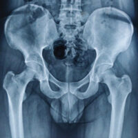 Figure 1: X-ray pelvis with both hips showing right femoral neck erosion, narrowing, and lytic lesions.