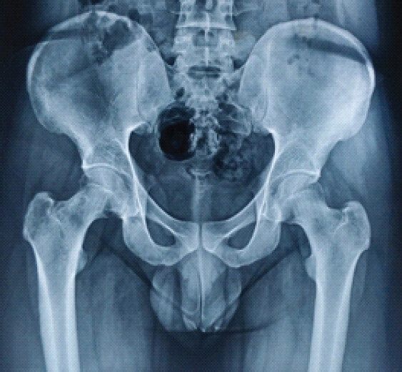 Figure 1: X-ray pelvis with both hips showing right femoral neck erosion, narrowing, and lytic lesions.