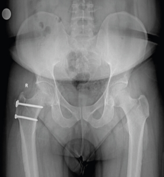 Figure 10: Four-year follow-up X-ray.