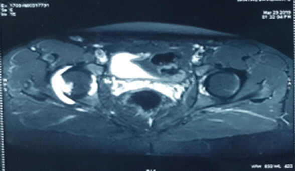 Figure 2: Magnetic resonance imaging axial image showing right hip synovitis and effusion.