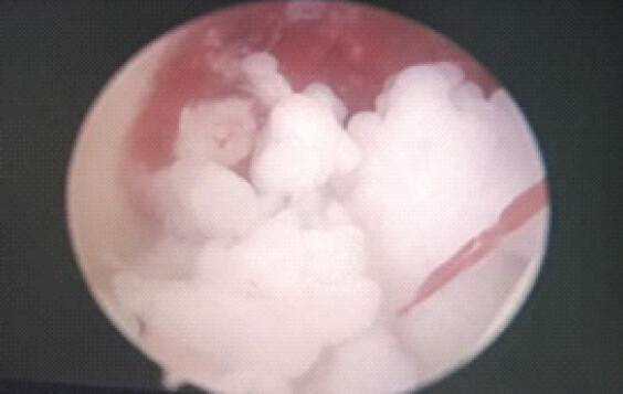 Figure 3: Multiple loose bodies (synovial chondromatosis).