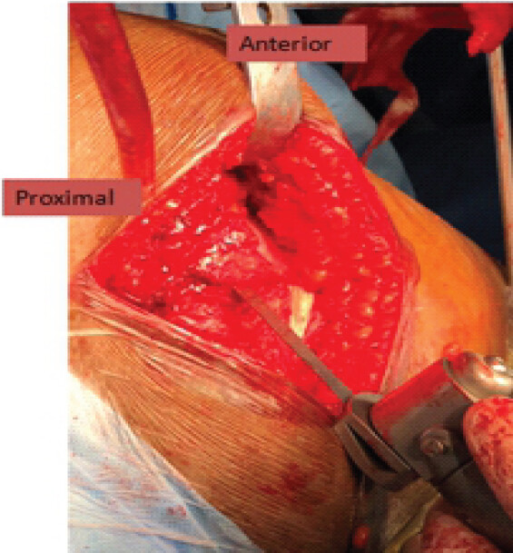 Figure 4: Trochanteric osteotomy.