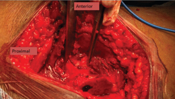 Figure5: Z’ Capsulotomy.
