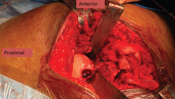 Figure 6: Erosions in the femoral neck.