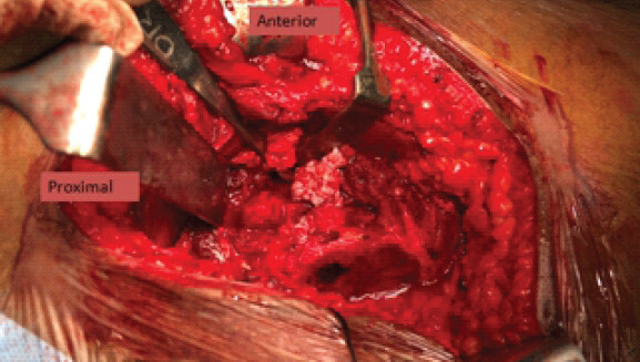 Figure 7: Removal of loose bodies.