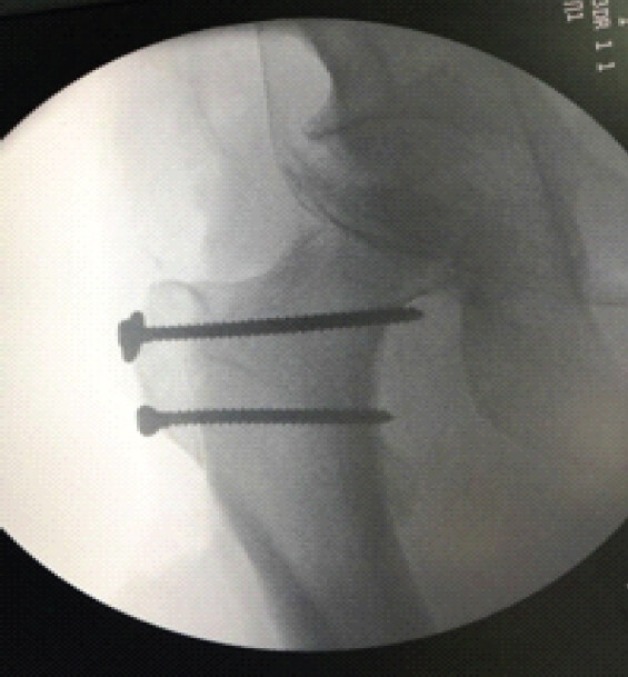 Figure 9: Osteotomy fixation.