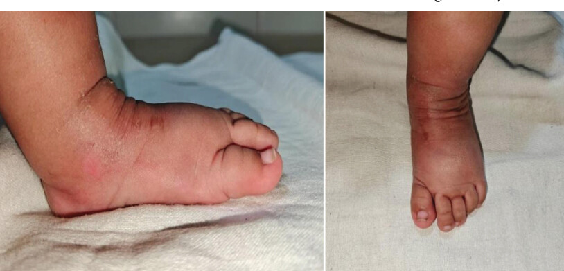 Figure 10: Clinical image depicts full correction of left foot at 4 yr treatment completion.