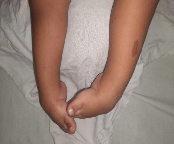 Figure 4: Four-month-old male child with Myelomeningocele (MMC) presented with bilateral clubfoot. Left foot had Pirani score 4.5 and Right foot with score of 4 as depicted.