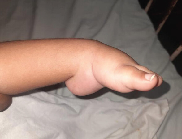 Figure 5: Left foot with initial Pirani score 4.5 at four month of Age .