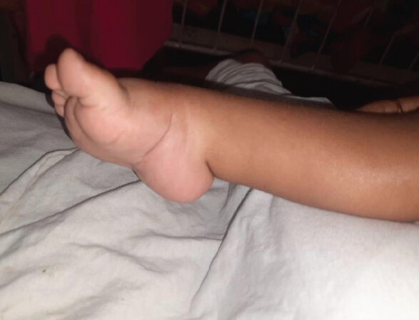Figure 6: Right foot having initial Pirani Score 4 at four-month Age. Child having a Midfoot score of 2 which included the Talar head coverage score 1, medial crease 0.5, curved lateral border 0.5 whereas the Hindfoot score were 2 in which equinus score was 1, posterior crease 0.5 and empty heel 0.5.