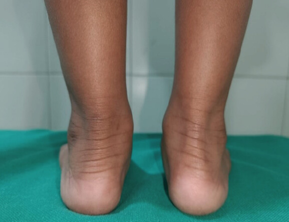 Figure 7: No Residual Equinus at mean follow-up of 4 years in the same MMC(Meningomyelocele) Child. This patient did require an AFO (Ankle Foot Orthoses) for a longer period due to weakness of dorsiflexors in the foot.
