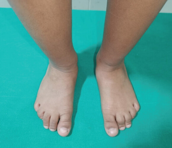 Figure 8: Full correction achieved at the completion of the Treatment. No Forefoot deformity and foot length compromise at the completion of treatment in the same MMC Child.