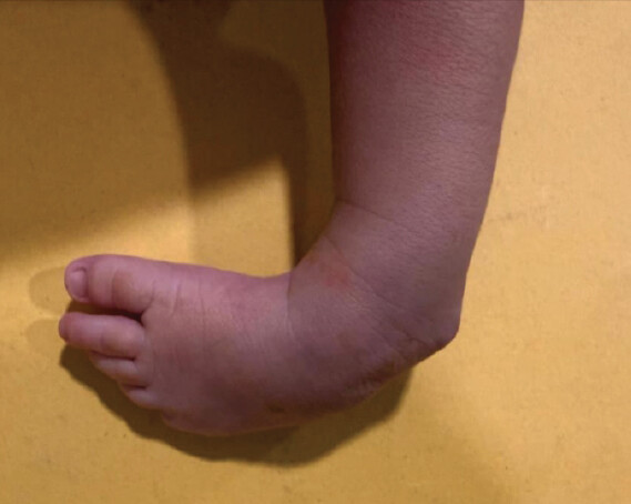 Figure 9: 2-month-old child with left sided unilateral idiopathic clubfoot and Pirani score is 5.
