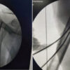 Minimally Invasive J-Nail Fixation for Neer Type 2, 3, and 4 Proximal Humerus Fractures in Elderly Patients: A Prospective Clinical and Radiological Outcome Study