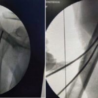Figure 1: Intraoperative fluoroscopic images (C-arm) demonstrating intramedullary nail fixation of a proximal humerus fracture. Intraoperative fluoroscopic images (C-arm X-rays) of the right shoulder and proximal humerus obtained during surgical fixation. The images show insertion and positioning of multiple flexible intramedullary nails across the fracture site for stabilization of a displaced proximal humerus fracture, with restoration of alignment of the humeral head relative to the shaft.