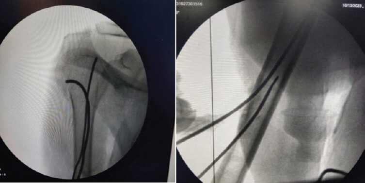 Figure 1: Intraoperative fluoroscopic images (C-arm) demonstrating intramedullary nail fixation of a proximal humerus fracture. Intraoperative fluoroscopic images (C-arm X-rays) of the right shoulder and proximal humerus obtained during surgical fixation. The images show insertion and positioning of multiple flexible intramedullary nails across the fracture site for stabilization of a displaced proximal humerus fracture, with restoration of alignment of the humeral head relative to the shaft.