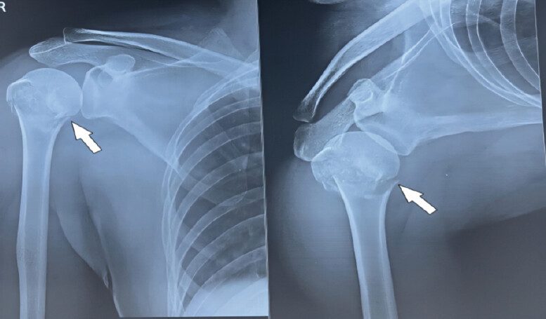 Figure 2: Pre-operative anteroposterior (left) and lateral (right) radiographs of the right shoulder showing a displaced proximal humerus fracture (arrow). Pre-operative plain radiographs (X-ray) of the right shoulder region, including the proximal humerus, obtained in anteroposterior (left) and lateral (right) views at initial presentation before surgical intervention. The images demonstrate a displaced fracture of the proximal humerus, with arrows indicating the fracture site and displacement of the humeral head fragment relative to the humeral shaft.