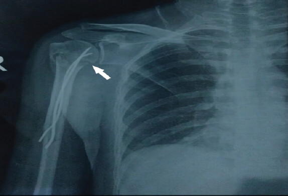 Figure 3: Anteroposterior radiograph of the right shoulder at 3 months postoperatively showing fixation with K-wires and maintained alignment of the proximal humerus fracture (arrow). Post-operative plain radiograph (X-ray) of the right shoulder and proximal humerus in anteroposterior view, obtained after surgical fixation. The image demonstrates multiple flexible intramedullary nails in situ stabilizing the proximal humerus fracture, with maintained alignment of the humeral head and shaft.