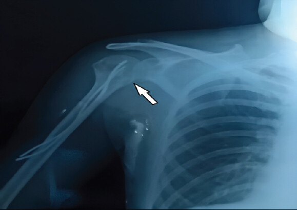 Figure 4: Anteroposterior radiograph of the right shoulder at 6 months follow-up demonstrating fracture union with satisfactory alignment (arrow). Plain radiograph (X-ray) of the right shoulder region, including the proximal humerus, obtained in anteroposterior view at 6 months following surgical fixation with flexible intramedullary nails. The image shows the nails in situ within the medullary canal, maintaining anatomical alignment of the humeral head relative to the shaft. There is clear evidence of fracture union with well-formed bridging callus and restoration of cortical continuity at the fracture site, as indicated by the arrow. No signs of implant migration, loosening, varus collapse, or secondary displacement are observed.