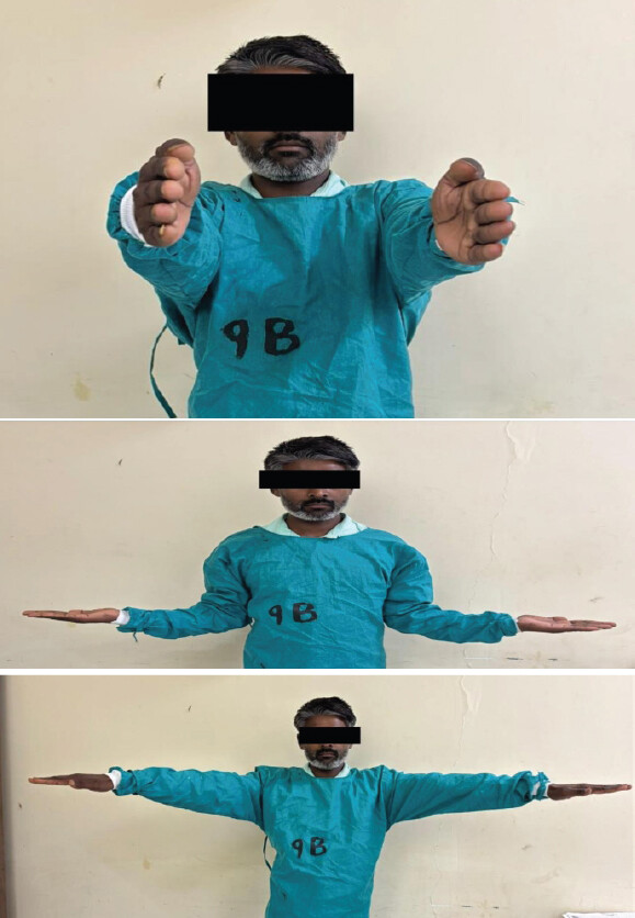 Figure 5: Range of motion after 6-month follow-up images. Clinical photographs of the patient obtained at 6 months following surgical fixation of a right proximal humerus fracture. The images demonstrate functional assessment of the right shoulder, including forward flexion (top), external rotation with arms at the side (middle), and shoulder abduction (bottom). The patient shows satisfactory range of motion with good restoration of shoulder function and symmetry compared to the contralateral side, indicating successful clinical recovery.