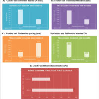 Figure 1: Gender-wise comparison of osteoconductive variables (a, b, c, d, e). Bar graphs illustrating the mean values (± SD) of five osteoconductive parameters in male (n = 7) and female (n = 3) bone callus samples: (a) Osteoblast density (N/mm2), (b) trabecular thickness (mm), (c) trabecular spacing (mm), (d) trabecular number (N/mm), and (e) bone volume fraction (%). Error bars represent standard deviation. Statistical comparison was performed using the unpaired Student’s t-test. NS: Not significant (P > 0.05). Male callus showed marginally higher osteoblast density and bone volume fraction compared to female samples; however, these differences did not reach statistical significance, attributed to the small pilot sample size (n = 10). N/mm2: Number per square millimeter, mm: Millimeter, N/mm: Number per millimeter, %: Percentage, SD: Standard deviation, M: Male, F: Female.