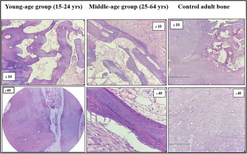 Figure 3: Microscopic comparison of bone callus specimens with control adult bone (hematoxylin and eosin [H&E], ×10 and ×40). Photomicrographs illustrating the histological features of bone callus and control bone stained with H&E: (a) younger age group (15–24 years); (b) middle-aged group (25–64 years); (c) control adult carpal bone (lunate). Panel A (young callus): Active bone remodeling with abundant osteoblasts lining the trabeculae, a prominent osteoconductive framework, dense trabecular network, and minimal intertrabecular spacing, reflecting vigorous bone regeneration. Panel B (middle-aged callus): Reduced osteoblast density along trabecular surfaces with comparatively wider intertrabecular spacing and lower trabecular number, consistent with an expected age-related decline in osteogenic activity. Panel C (control adult lunate): Mature lamellar bone architecture with osteocytes housed in lacunae, regular Haversian systems, and a quiescent periosteal surface; serves as the structural reference for adult cortical bone. All sections were stained with hematoxylin and eosin. Photomicrographs were captured using a binocular light microscope and quantified with ImageJ software. Objective magnification as indicated within each panel (×10 and ×40); no calibrated scale bar was superimposed on the photomicrographs. ImageJ: Image analysis software (NIH, USA), OB: Osteoblast, OC: Osteocyte, T: Trabecula, M: Marrow space, H: Haversian canal. Control: Adult carpal bone (lunate) obtained from an age-matched cadaveric specimen. A and B: Bone callus test samples, C: Control adult bone.