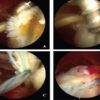 Functional Outcomes of Arthroscopic Double-Row Repair Using Single Anchors in Each Row for Massive Rotator Cuff Tears