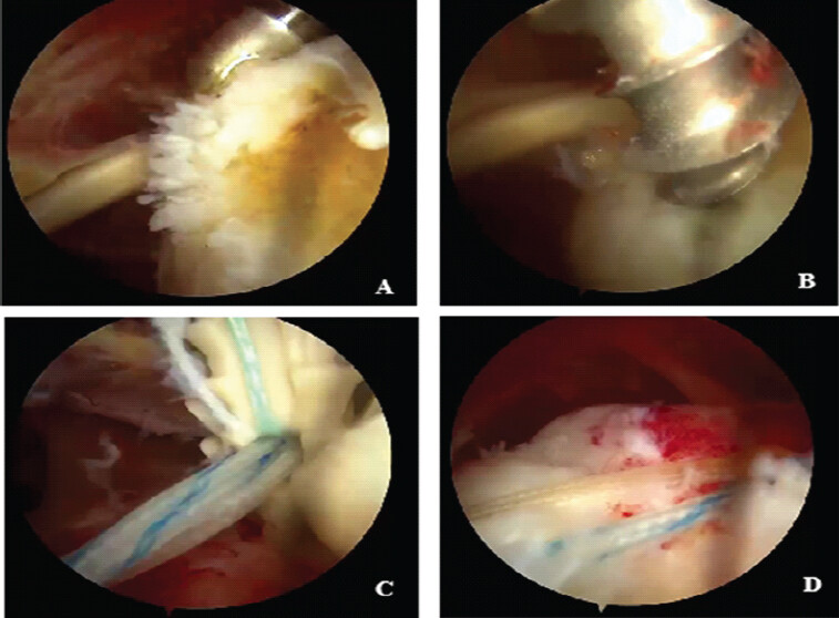 Figure 1: Intraoperative arthroscopic steps of the single-anchor double-row (SADR) Technique. Arthroscopic views demonstrating the key steps of the SADR repair. (a) Decortication of the greater tuberosity to prepare the footprint (b) Placement of the single medial anchor at the articular margin. (c) Insertion of the single knotless lateral anchor, capturing the bridging sutures from the medial row. (d) The final SADR construct demonstrating tissue compression against the footprint using a minimalist two-anchor configuration.