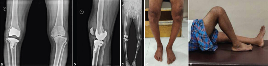 Figure 1: (a, b, c) Pre-operative X-rays and (d and e) clinical images of a 52-year-old male with 5 years old operated right total knee arthroplasty.