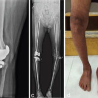 Figure 1: (a, b, c) Pre-operative X-rays and (d and e) clinical images of a 52-year-old male with 5 years old operated right total knee arthroplasty.