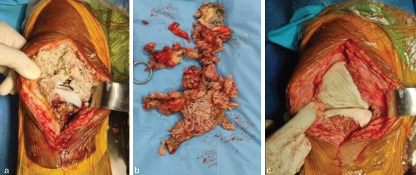 Figure 2: Intraoperative images (a and b) previous implants with inflamed synovium and synovectomy, and (c) preparation of cement spacer and molding of condyles with cement.