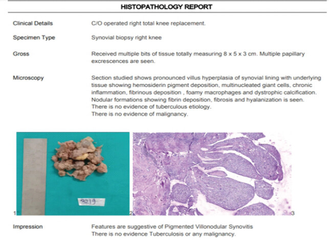 Figure 3: Histopathology report of synovium sample confirming it to be pigmented villonodular synovitis.