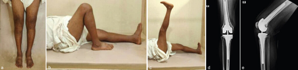 Figure 4: (a, b, c, d, e) 1.5 years follow-up clinical images and X-rays of a 52-year-old male with the right revision total knee arthroplasty.
